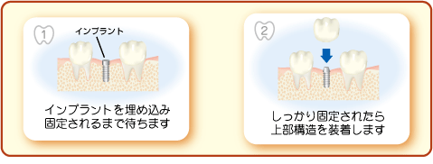 インプラントとは?