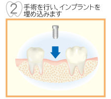 2,手術を行い、インプラントを埋め込みます