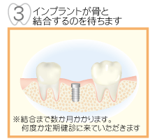 3,インプラントが骨と接合するのを待ちます