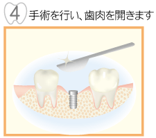 4,手術を行い、歯肉を開きます