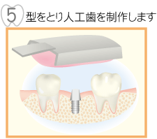 5,型をとり人工歯を制作します