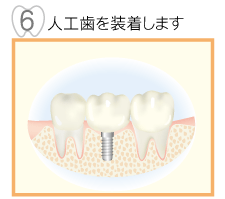 6,人工歯を装着します