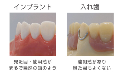 第2の永久歯。まるで自分の歯のよう