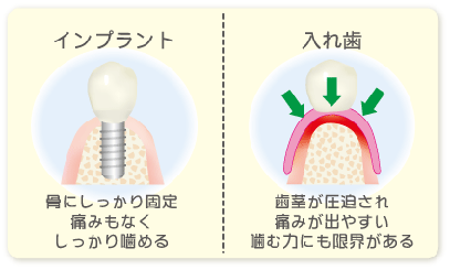 インプラントがしっかり噛める理由