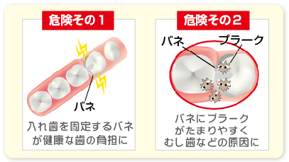 部分入れ歯の2つの危険性