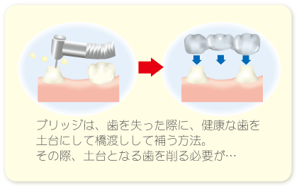 土台の歯を削る必要のあるブリッジ