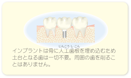 インプラントなら土台の歯が不要