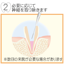 2,必要に応じて神経を削ります。