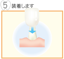 5,装着します。