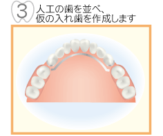 3,人工歯を並べ、仮の入れ歯を作成します。