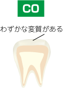 自覚症状がなくても虫歯はある！！