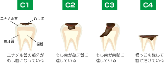 しみたり、痛みを感じたらもう手遅れ！
